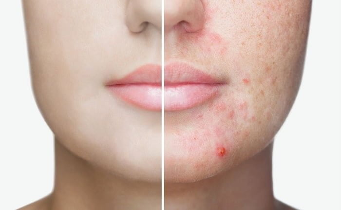 Bicarbonato de Sodio Propiedades Curativas para acne